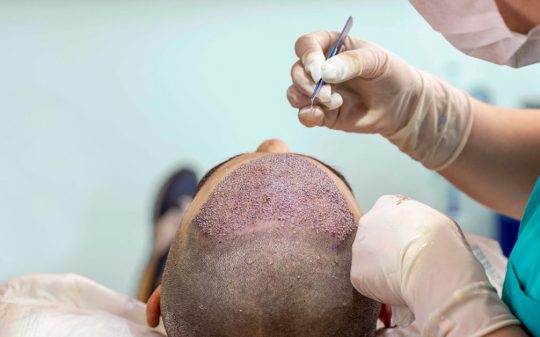 Hair-transplant-surgery-1200x628-facebook-1200x628